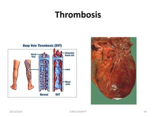Thrombosis
10/13/2018 69SUNIL KUMAR P
 
