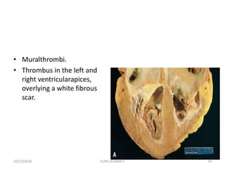 • Muralthrombi.
• Thrombus in the left and
right ventricularapices,
overlying a white fibrous
scar.
10/13/2018 70SUNIL KUMAR P
 