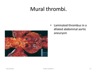 Mural thrombi.
• Laminated thrombus in a
dilated abdominal aortic
aneurysm
10/13/2018 71SUNIL KUMAR P
 