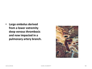• Large embolus derived
from a lower extremity
deep venous thrombosis
and now impacted in a
pulmonary artery branch.
10/13/2018 80SUNIL KUMAR P
 