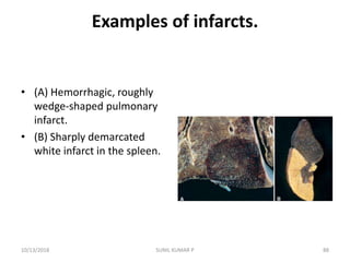 Examples of infarcts.
• (A) Hemorrhagic, roughly
wedge-shaped pulmonary
infarct.
• (B) Sharply demarcated
white infarct in the spleen.
10/13/2018 88SUNIL KUMAR P
 