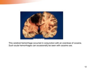12
This cerebral hemorrhage occurred in conjunction with an overdose of cocaine.
Such acute hemorrhages can occasionally be seen with cocaine use.
 