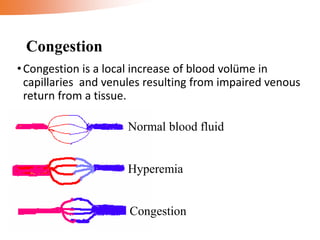 •Congestion is a local increase of blood volüme in
capillaries and venules resulting from impaired venous
return from a tissue.
Congestion
Normal blood fluid
Hyperemia
Congestion
 