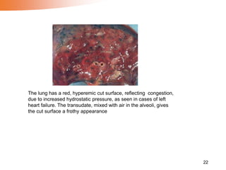 22
The lung has a red, hyperemic cut surface, reflecting congestion,
due to increased hydrostatic pressure, as seen in cases of left
heart failure. The transudate, mixed with air in the alveoli, gives
the cut surface a frothy appearance
 