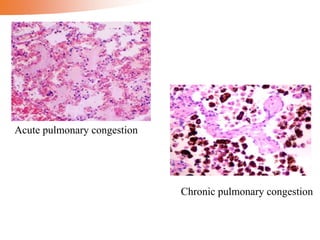 Acute pulmonary congestion
Chronic pulmonary congestion
 