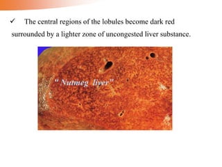  The central regions of the lobules become dark red
surrounded by a lighter zone of uncongested liver substance.
“ Nutmeg liver”
 