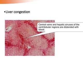 •Liver congestion
Central veins and hepatic sinuses of the
centrilobular regions are distended with
blood.
 
