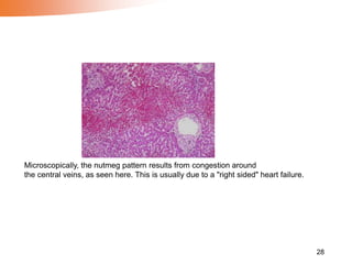 28
Microscopically, the nutmeg pattern results from congestion around
the central veins, as seen here. This is usually due to a "right sided" heart failure.
 