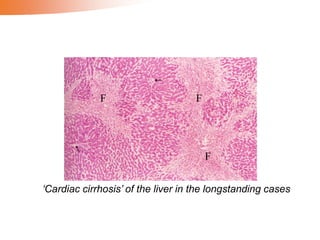 ‘Cardiac cirrhosis’ of the liver in the longstanding cases
F
F
F
 