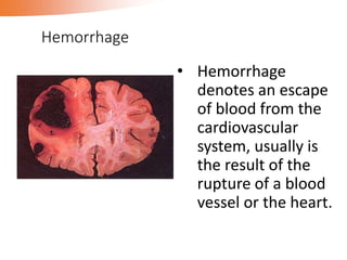 Hemorrhage
• Hemorrhage
denotes an escape
of blood from the
cardiovascular
system, usually is
the result of the
rupture of a blood
vessel or the heart.
 