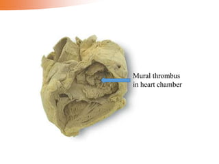 Mural thrombus
in heart chamber
 