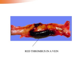 RED THROMBUS IN A VEIN
 