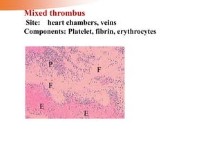 Mixed thrombus
Site: heart chambers, veins
Components: Platelet, fibrin, erythrocytes
E
E
F
P
F
 
