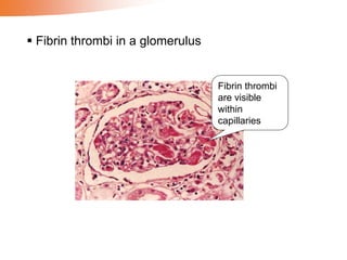 Fibrin thrombi
are visible
within
capillaries
 Fibrin thrombi in a glomerulus
 