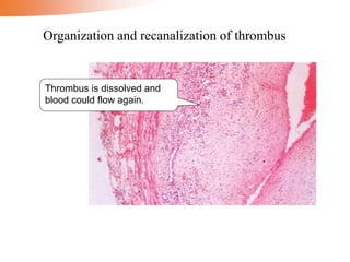 Organization and recanalization of thrombus
Thrombus is dissolved and
blood could flow again.
 