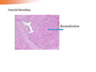 Recanalization
Arterial thrombus
 