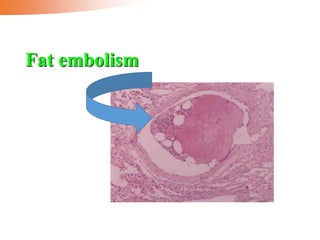 Fat embolism
 