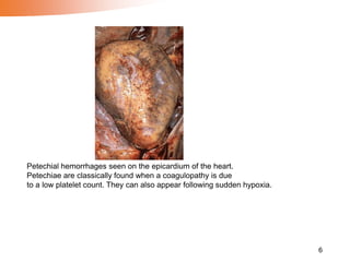 6
Petechial hemorrhages seen on the epicardium of the heart.
Petechiae are classically found when a coagulopathy is due
to a low platelet count. They can also appear following sudden hypoxia.
 
