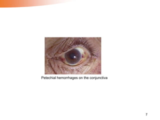 7
Petechial hemorrhages on the conjunctiva
 