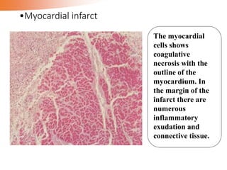 •Myocardial infarct
The myocardial
cells shows
coagulative
necrosis with the
outline of the
myocardium. In
the margin of the
infarct there are
numerous
inflammatory
exudation and
connective tissue.
 