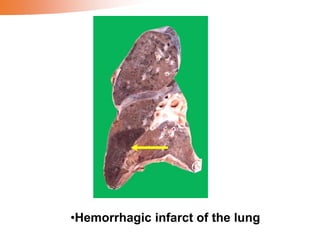 •Hemorrhagic infarct of the lung
 