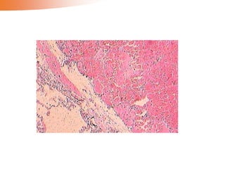 Hemodynamic disorders 