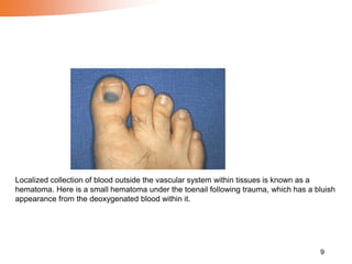 9
Localized collection of blood outside the vascular system within tissues is known as a
hematoma. Here is a small hematoma under the toenail following trauma, which has a bluish
appearance from the deoxygenated blood within it.
 