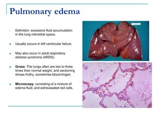 Pulmonary edema
• Definition: excessive fluid accumulation
in the lung interstitial space.
 Usually occurs in left ventricular failure.
 May also occur in adult respiratory
distress syndrome (ARDS).
 Gross: The lungs often are two to three
times their normal weight, and sectioning
shows frothy, sometimes blood-tinged.
 Microscopy: consisting of a mixture of
edema fluid, and extravasated red cells.
 
