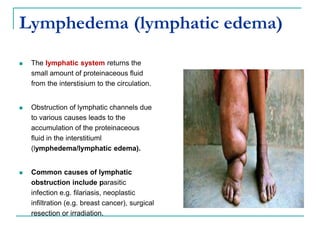 Lymphedema (lymphatic edema)
 The lymphatic system returns the
small amount of proteinaceous fluid
from the interstisium to the circulation.
 Obstruction of lymphatic channels due
to various causes leads to the
accumulation of the proteinaceous
fluid in the interstitiuml
(lymphedema/lymphatic edema).
 Common causes of lymphatic
obstruction include parasitic
infection e.g. filariasis, neoplastic
infiltration (e.g. breast cancer), surgical
resection or irradiation.
 