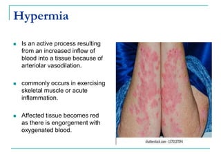 Hypermia
 Is an active process resulting
from an increased inflow of
blood into a tissue because of
arteriolar vasodilation.
 commonly occurs in exercising
skeletal muscle or acute
inflammation.
 Affected tissue becomes red
as there is engorgement with
oxygenated blood.
 