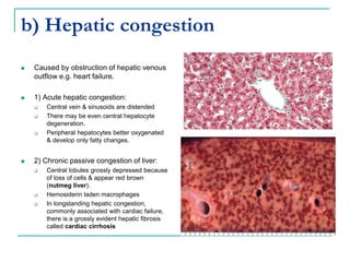 b) Hepatic congestion
 Caused by obstruction of hepatic venous
outflow e.g. heart failure.
 1) Acute hepatic congestion:
 Central vein & sinusoids are distended
 There may be even central hepatocyte
degeneration.
 Peripheral hepatocytes better oxygenated
& develop only fatty changes.
 2) Chronic passive congestion of liver:
 Central lobules grossly depressed because
of loss of cells & appear red brown
(nutmeg liver).
 Hemosiderin laden macrophages
 In longstanding hepatic congestion,
commonly associated with cardiac failure,
there is a grossly evident hepatic fibrosis
called cardiac cirrhosis
 