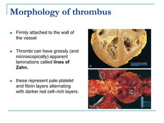 Morphology of thrombus
 Firmly attached to the wall of
the vessel
 Thrombi can have grossly (and
microscopically) apparent
laminations called lines of
Zahn.
 these represent pale platelet
and fibrin layers alternating
with darker red cell–rich layers.
 