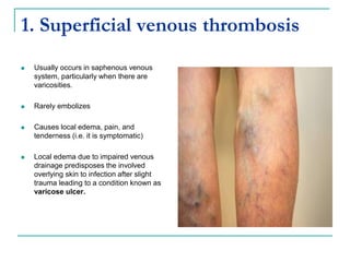 1. Superficial venous thrombosis
 Usually occurs in saphenous venous
system, particularly when there are
varicosities.
 Rarely embolizes
 Causes local edema, pain, and
tenderness (i.e. it is symptomatic)
 Local edema due to impaired venous
drainage predisposes the involved
overlying skin to infection after slight
trauma leading to a condition known as
varicose ulcer.
 
