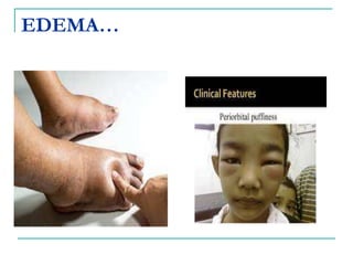 EDEMA…
 
