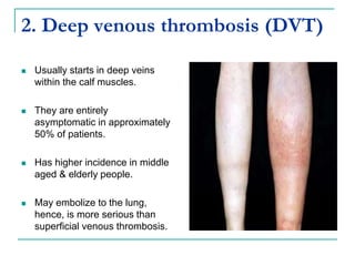2. Deep venous thrombosis (DVT)
 Usually starts in deep veins
within the calf muscles.
 They are entirely
asymptomatic in approximately
50% of patients.
 Has higher incidence in middle
aged & elderly people.
 May embolize to the lung,
hence, is more serious than
superficial venous thrombosis.
 