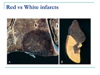 Red vs White infarcts
 