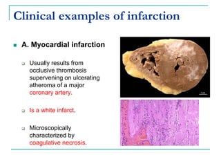 Clinical examples of infarction
 A. Myocardial infarction
 Usually results from
occlusive thrombosis
supervening on ulcerating
atheroma of a major
coronary artery.
 Is a white infarct.
 Microscopically
characterized by
coagulative necrosis.
 