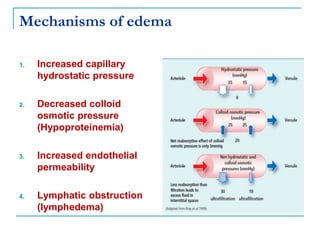 Mechanisms of edema
1. Increased capillary
hydrostatic pressure
2. Decreased colloid
osmotic pressure
(Hypoproteinemia)
3. Increased endothelial
permeability
4. Lymphatic obstruction
(lymphedema)
 