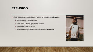 EFFUSION
• Fluid accumulations in body cavities is known as effusions
• Pleural cavity – hydrothorax
• Pericardial cavity – hydro pericardium
• Peritoneal cavity – ascites
• Severe swelling of subcutaneous tissues – Anasarca
 