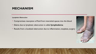 MECHANISM
Lymphatic Obstruction
• Compromises resorption of fluid from interstitial spaces into the blood
• Edema due to lymphatic obstruction is called lymphedema
• Results from a localized obstruction due to inflammation, neoplasia, surgery
 