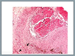 Comprehensive Overview of Hemostasis and Thrombosis Mechanisms and ...