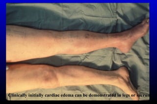 Clinically initially cardiac edema can be demonstrated in legs or sacrum
 