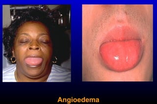 Angioedema
 