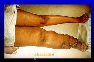 Elephantiasi
s
 