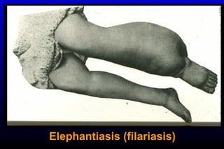 Elephantiasis (filariasis)
 