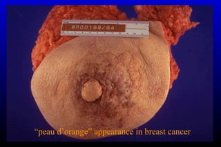 “peau d’orange” appearance in breast cancer
 