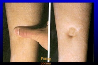 Pitting
edema
 