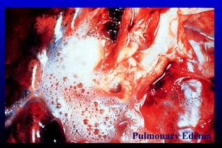Pulmonary Edema
 