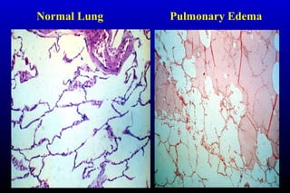 Pulmonary EdemaNormal Lung
 