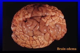 Brain edema
 